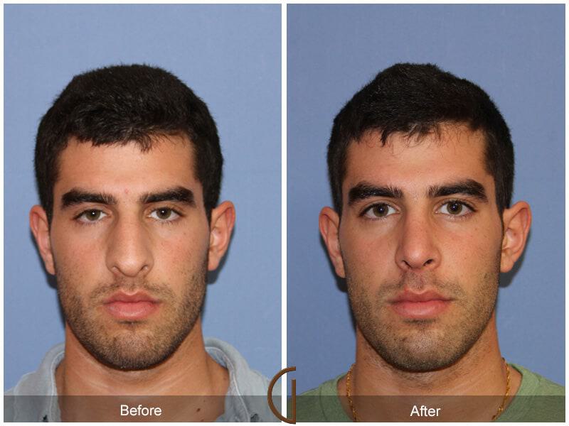 Male Rhinoplasty Before & After Photo