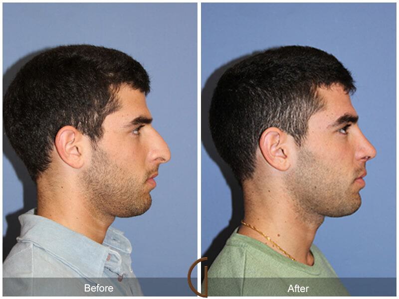 Male Rhinoplasty Before & After Photo