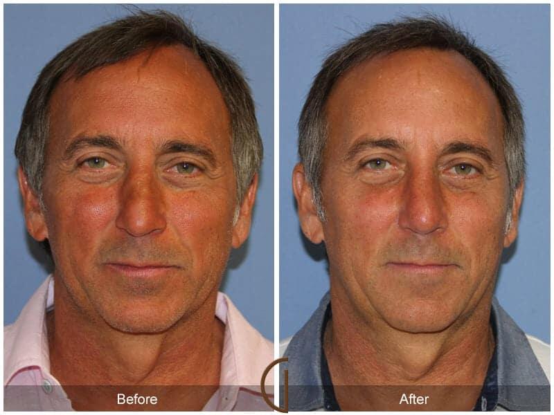 Male Rhinoplasty Before & After Photo