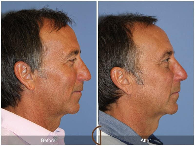 Male Rhinoplasty Before & After Photo