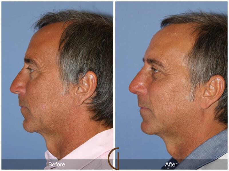 Male Rhinoplasty Before & After Photo