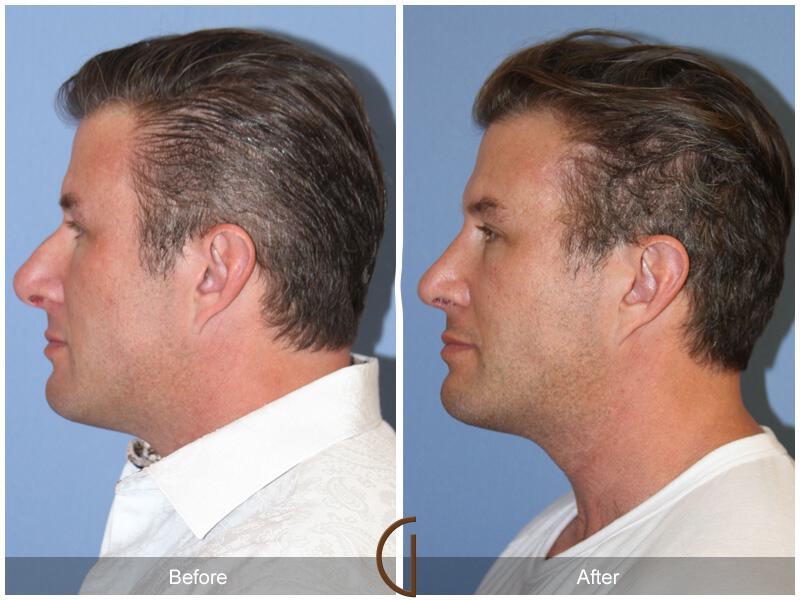 Male Rhinoplasty Before & After Photo