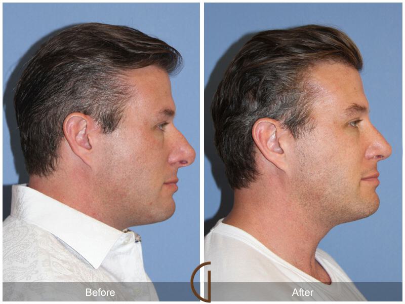 Male Rhinoplasty Before & After Photo