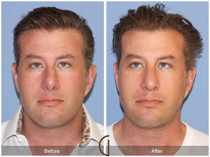 Male Rhinoplasty Before & After Photo