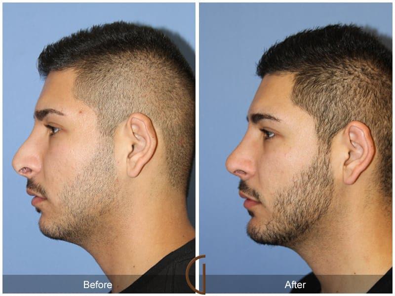 Male Rhinoplasty Before & After Photo