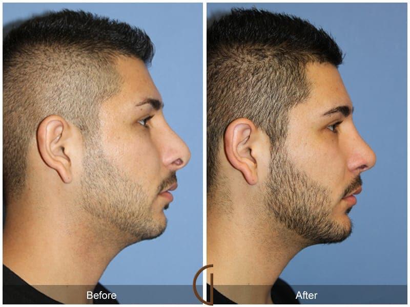 Male Rhinoplasty Before & After Photo