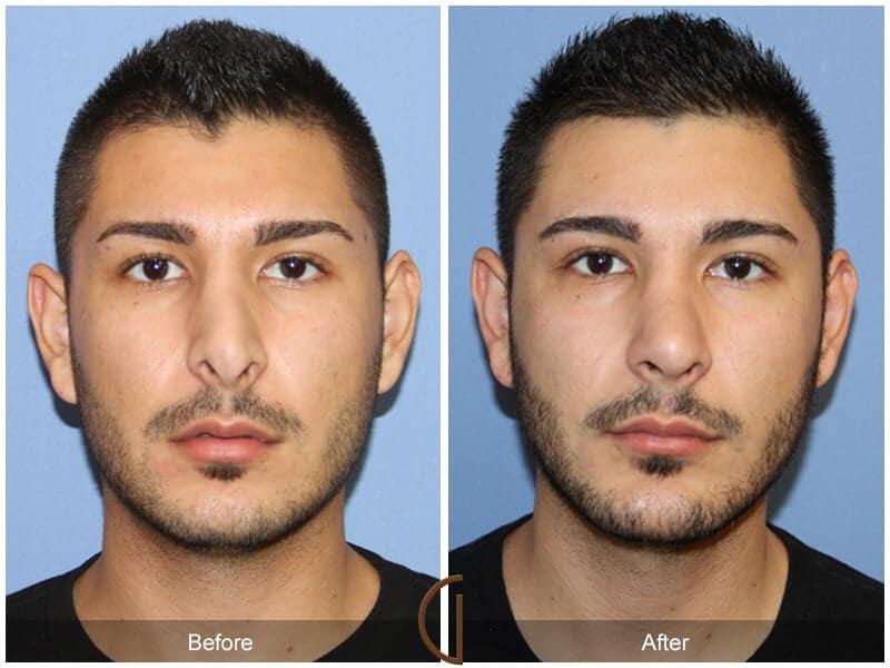 Male Rhinoplasty Before & After Photo