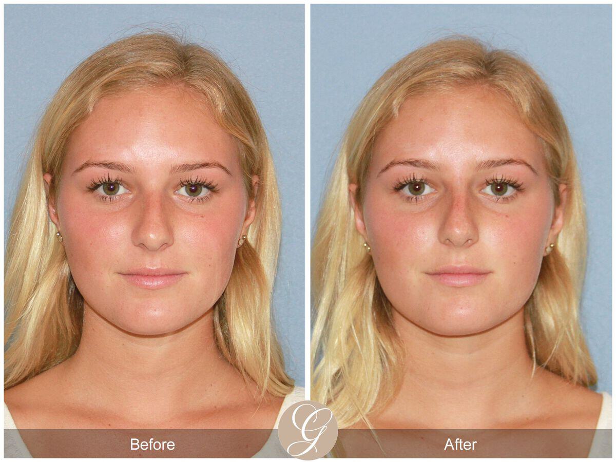 Non-Surgical Rhinoplasty Before & After Photo