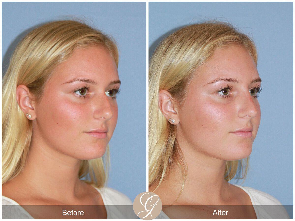 Non-Surgical Rhinoplasty Before & After Photo