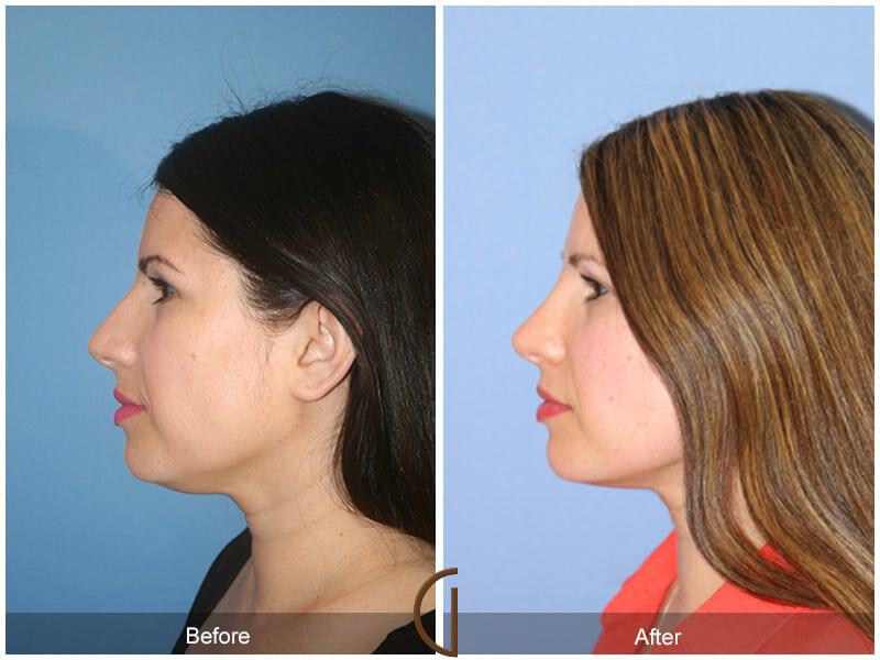 Revision Rhinoplasty Before & After Photo