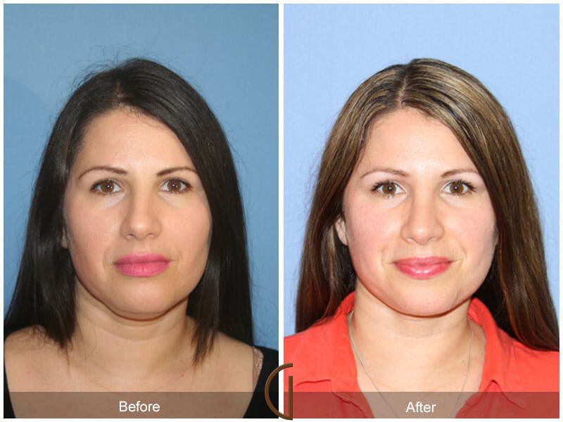 Revision Rhinoplasty Before & After Photo