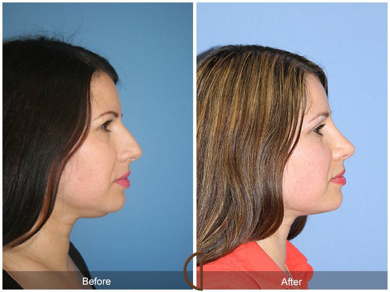 Revision Rhinoplasty Before & After Photo