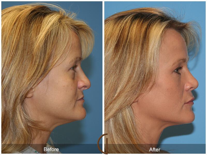 Revision Rhinoplasty Before & After Photo