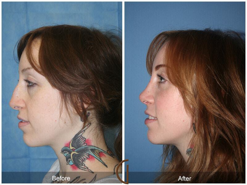 Revision Rhinoplasty Before & After Photo