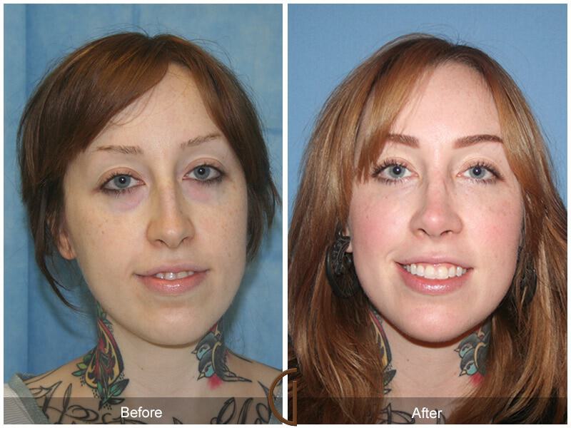 Revision Rhinoplasty Before & After Photo