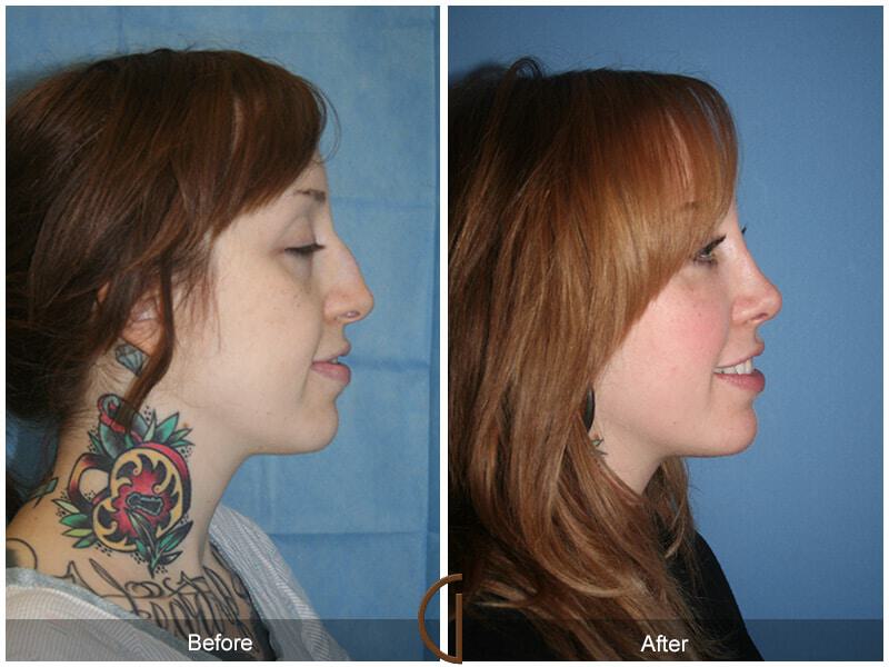 Revision Rhinoplasty Before & After Photo