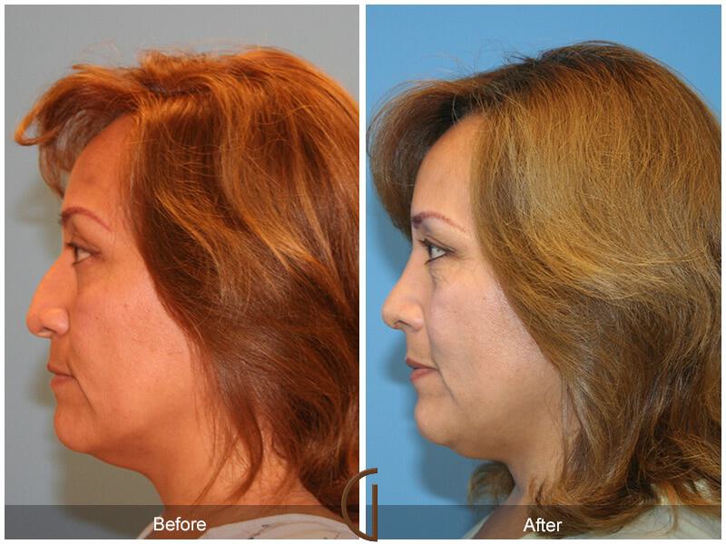 Revision Rhinoplasty Before & After Photo