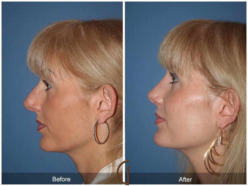 Revision Rhinoplasty Before & After Photo