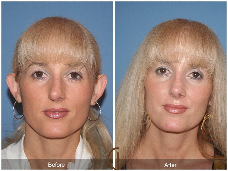 Revision Rhinoplasty Before & After Photo