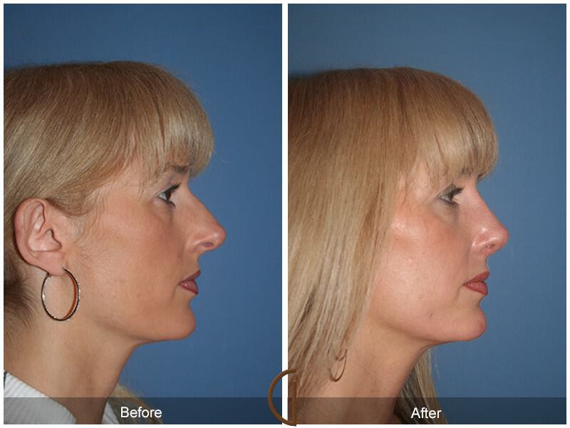 Revision Rhinoplasty Before & After Photo