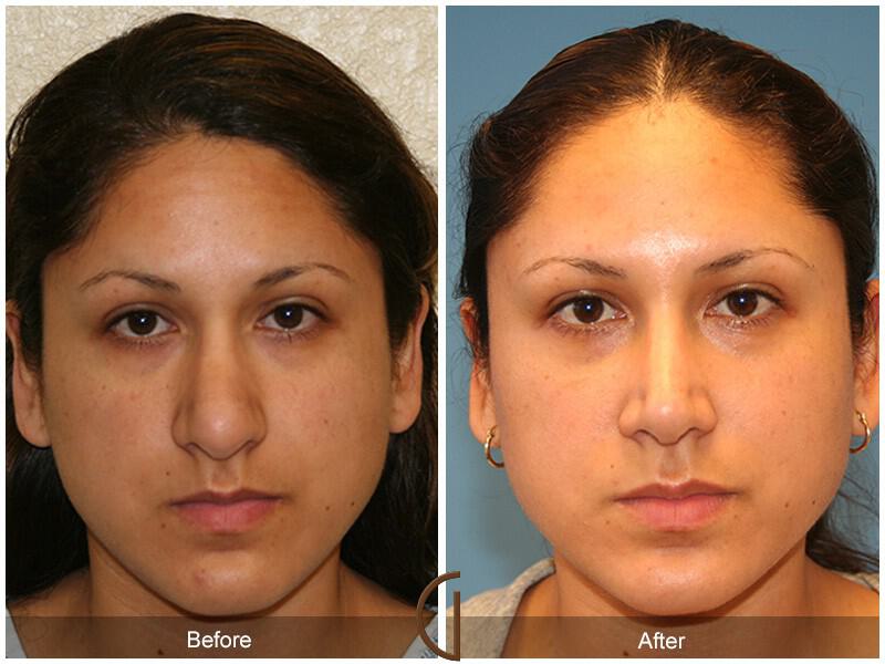 Revision Rhinoplasty Before & After Photo