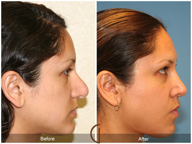 Revision Rhinoplasty Before & After Photo