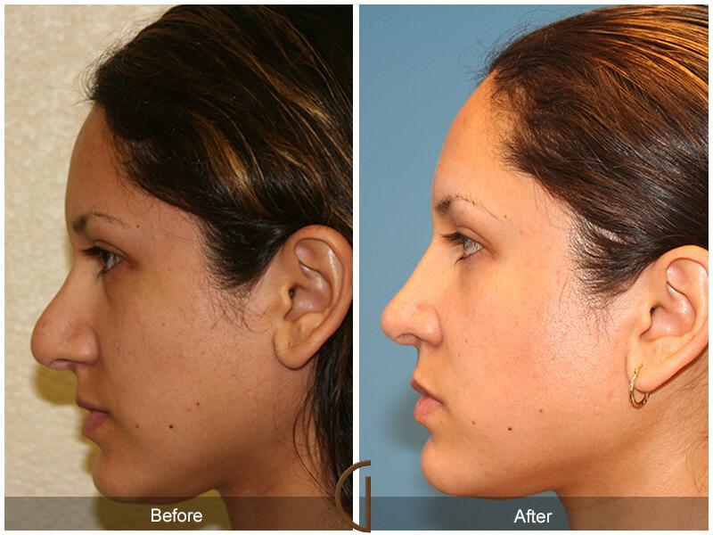 Revision Rhinoplasty Before & After Photo