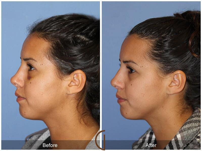 Revision Rhinoplasty Before & After Photo