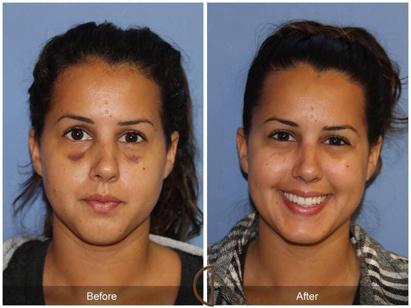 Revision Rhinoplasty Before & After Photo