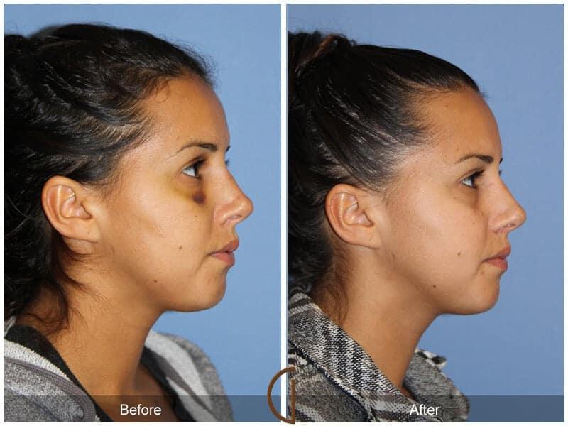 Revision Rhinoplasty Before & After Photo