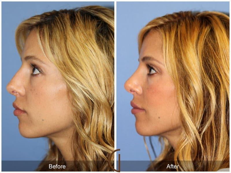 Revision Rhinoplasty Before & After Photo