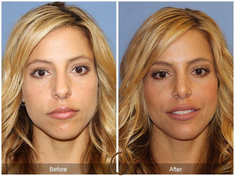 Revision Rhinoplasty Before & After Photo