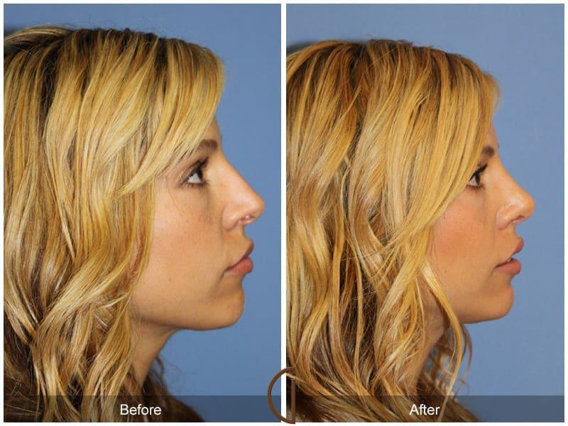 Revision Rhinoplasty Before & After Photo