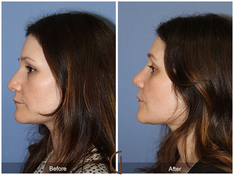 Revision Rhinoplasty Before & After Photo