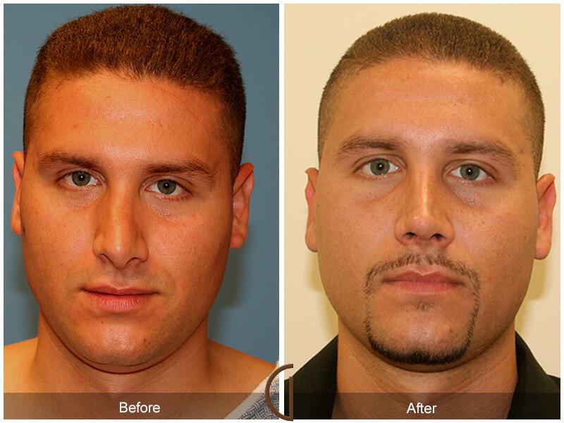 Revision Rhinoplasty Before & After Photo