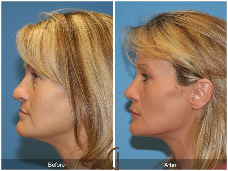 Revision Rhinoplasty Before & After Photo