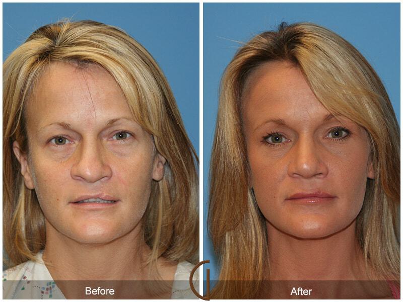 Revision Rhinoplasty Before & After Photo