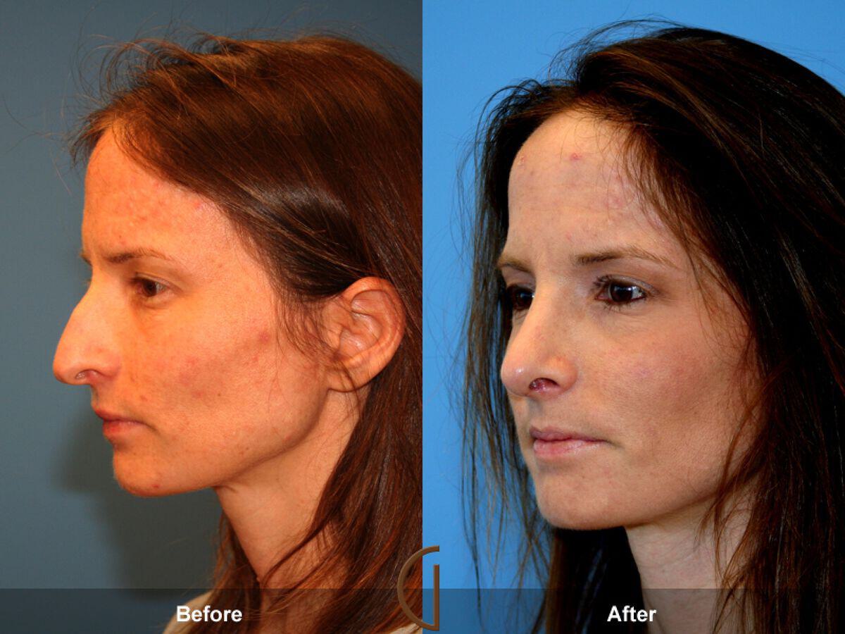 Revision Rhinoplasty Before & After Photo