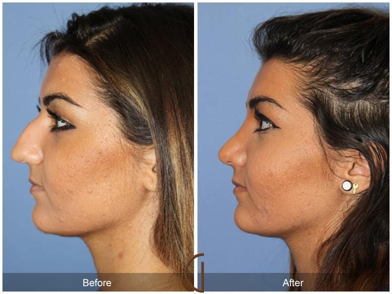 Rhinoplasty Before & After Photo