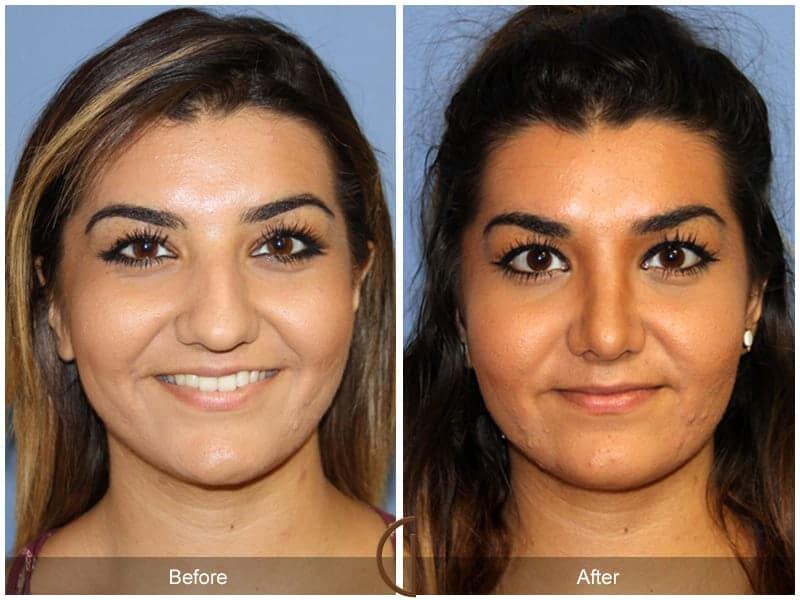 Rhinoplasty Before & After Photo