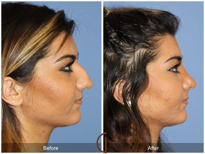 Rhinoplasty Before & After Photo