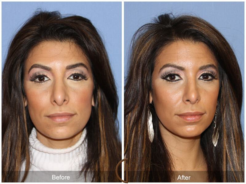 Rhinoplasty Before & After Photo