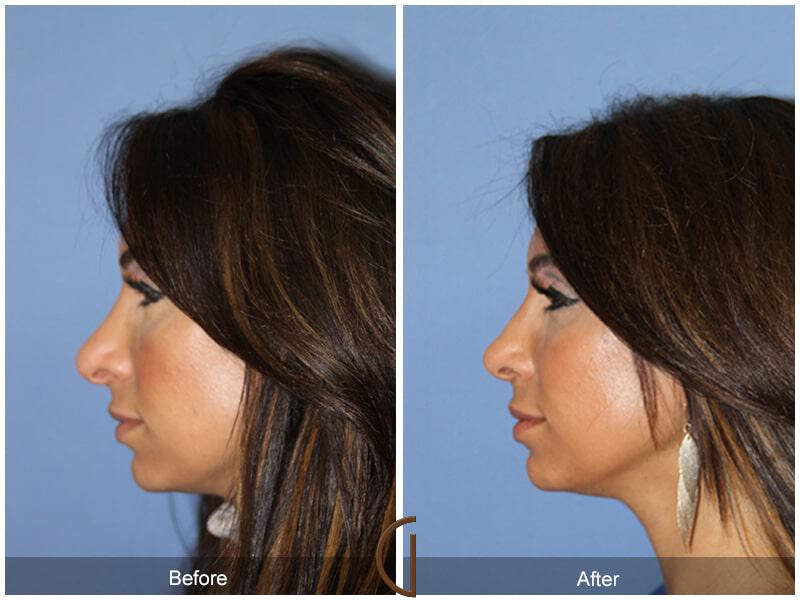 Rhinoplasty Before & After Photo