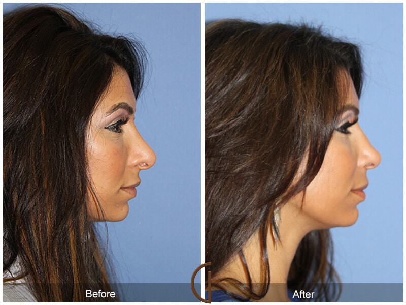 Rhinoplasty Before & After Photo