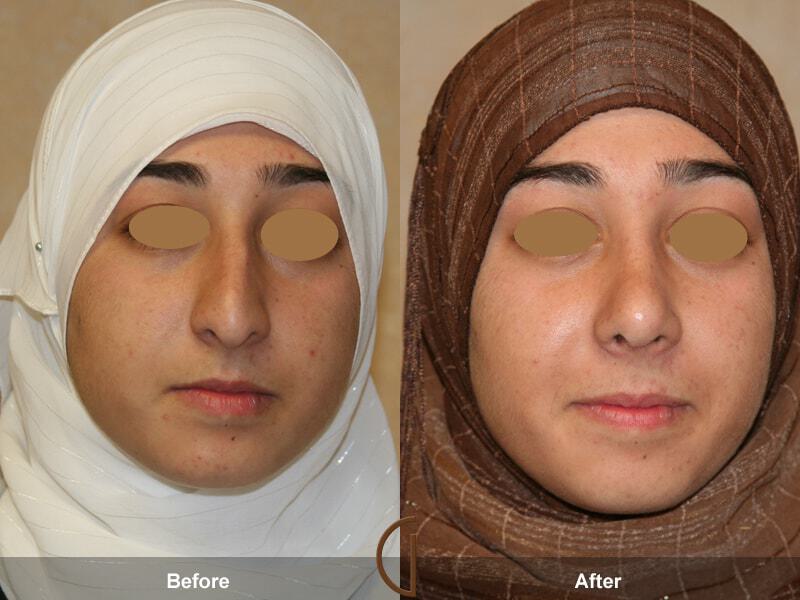 Rhinoplasty Before & After Photo