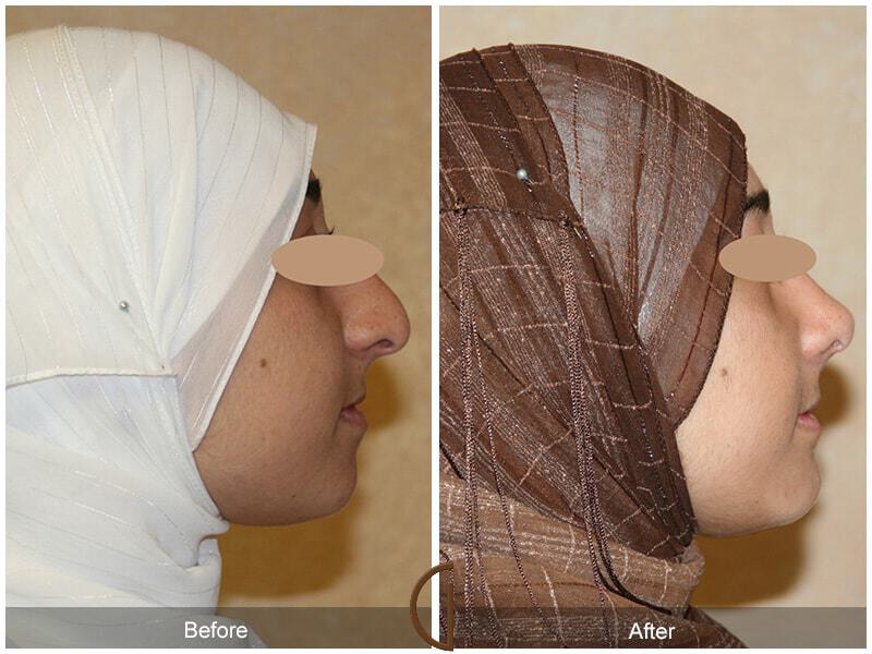 Rhinoplasty Before & After Photo