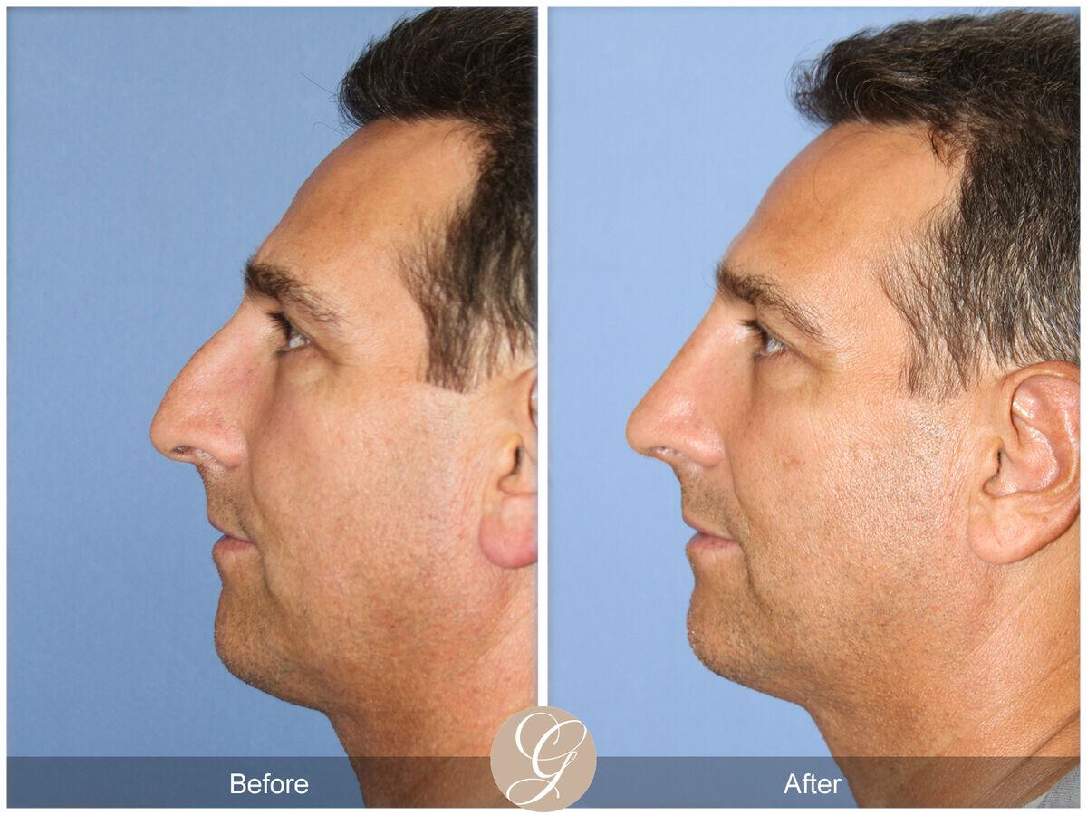 Rhinoplasty Before & After Photo