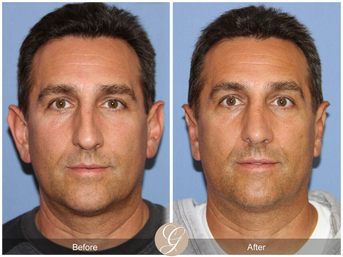 Rhinoplasty Before & After Photo