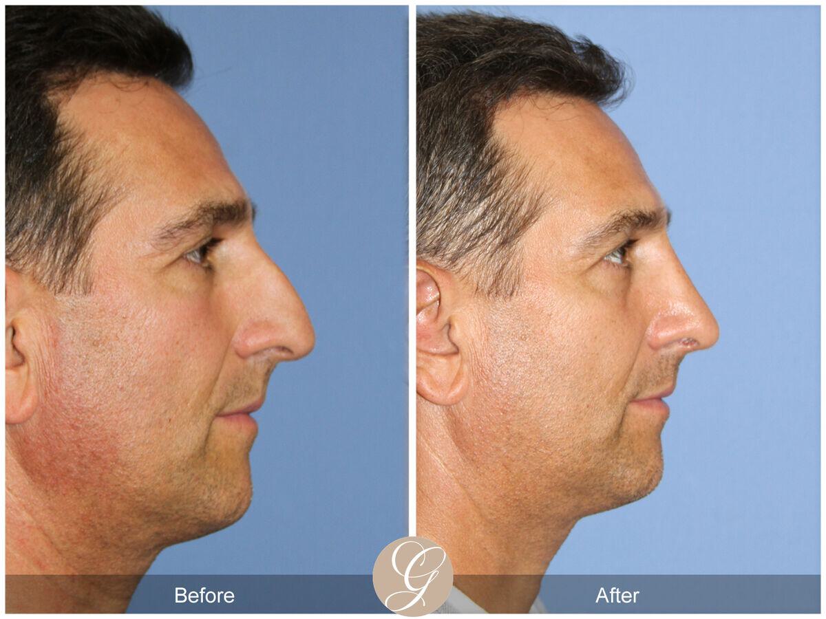 Rhinoplasty Before & After Photo