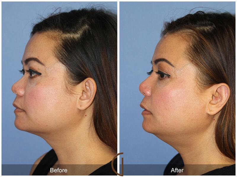 Rhinoplasty Before & After Photo